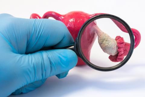 Ендометріоз.Лікування.Арекур